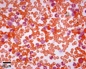 ChrMyelogenousLeuk