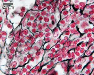 Lymphocytes in the meshwork of reticular fibres