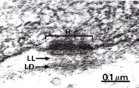 Electron micrograph showing a Hemidesmosome