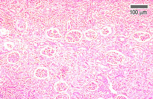Damaged kidney