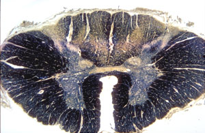 Diseased spinal cord